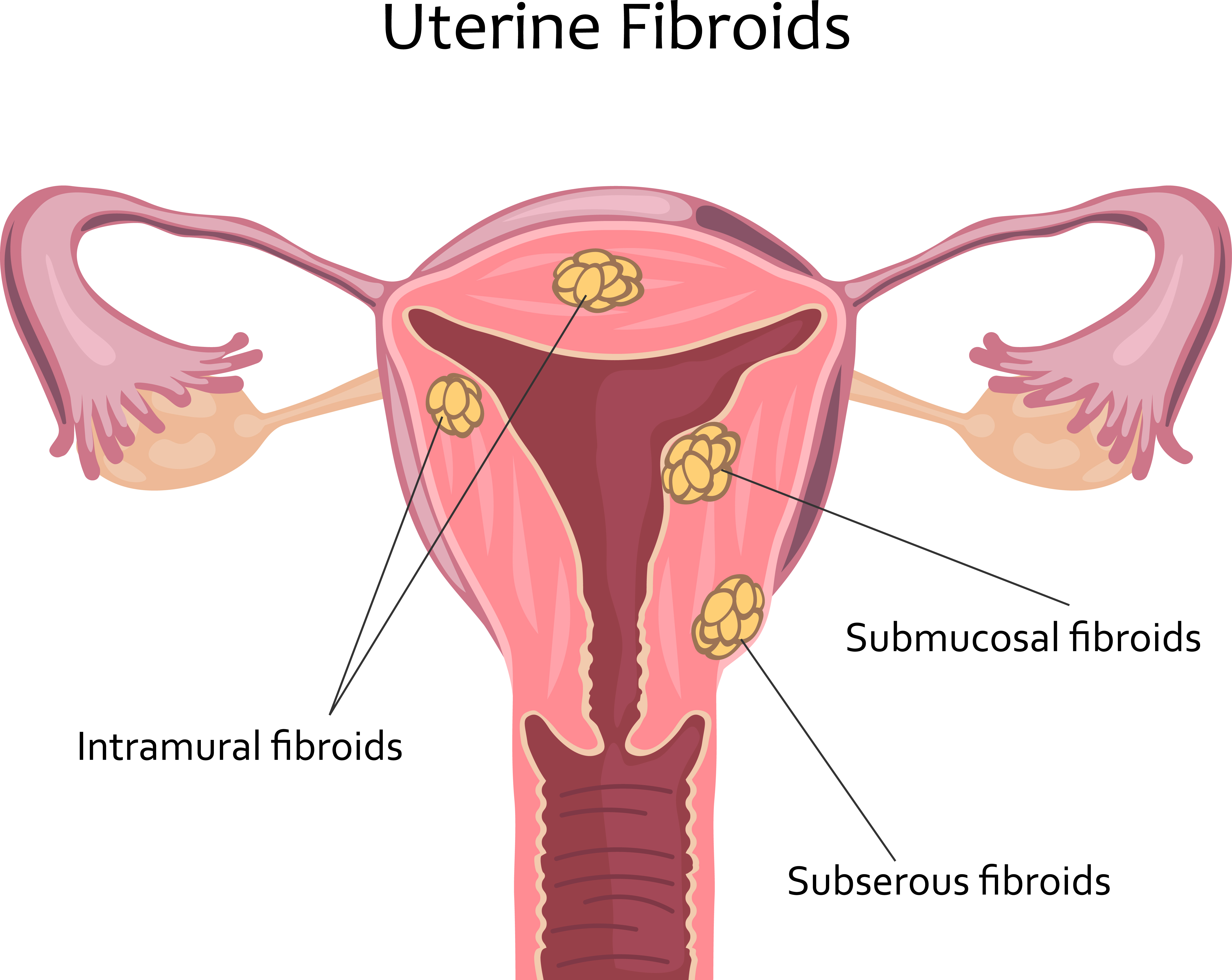 Fibroids image 