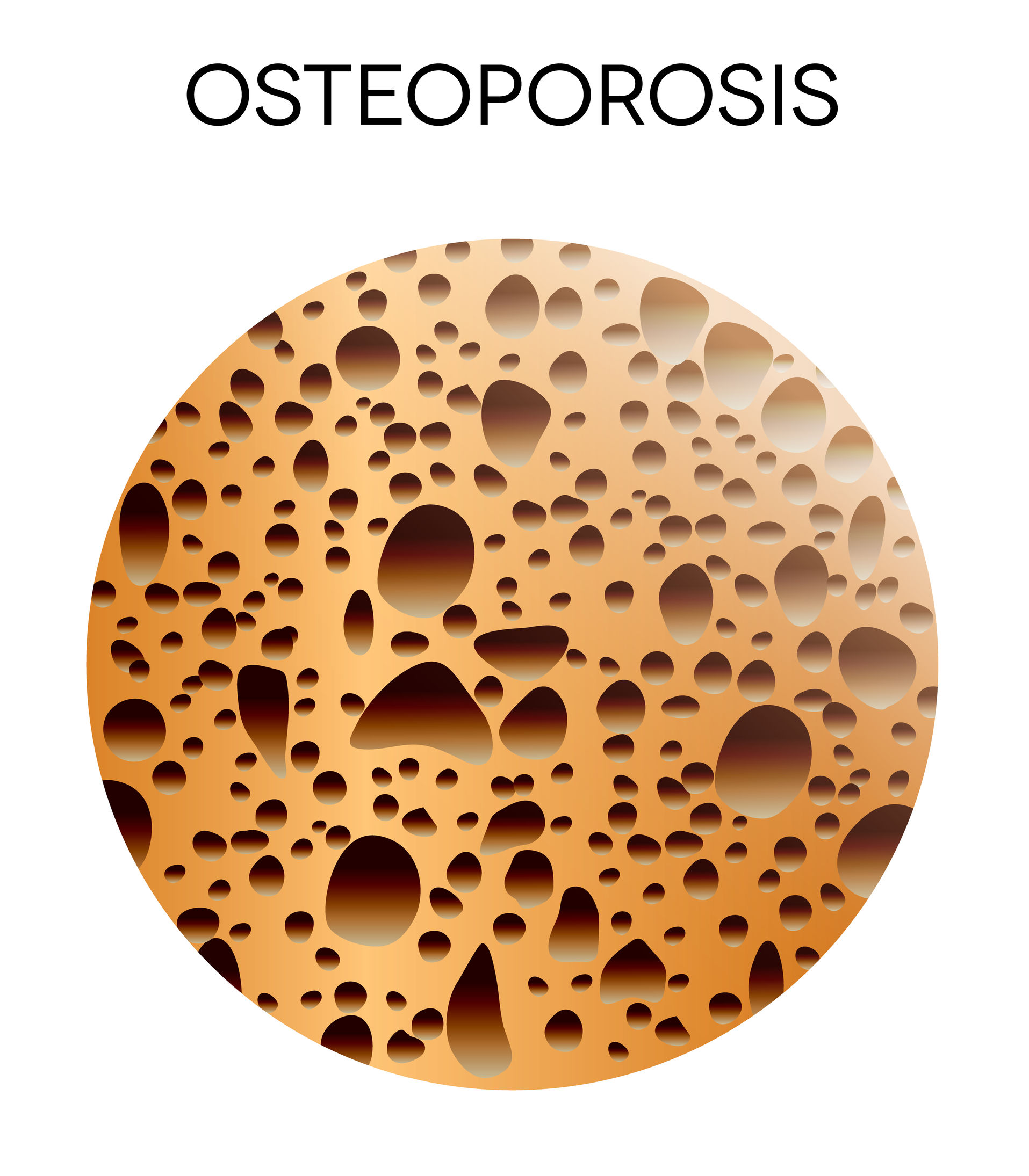 Osteoporosis image 