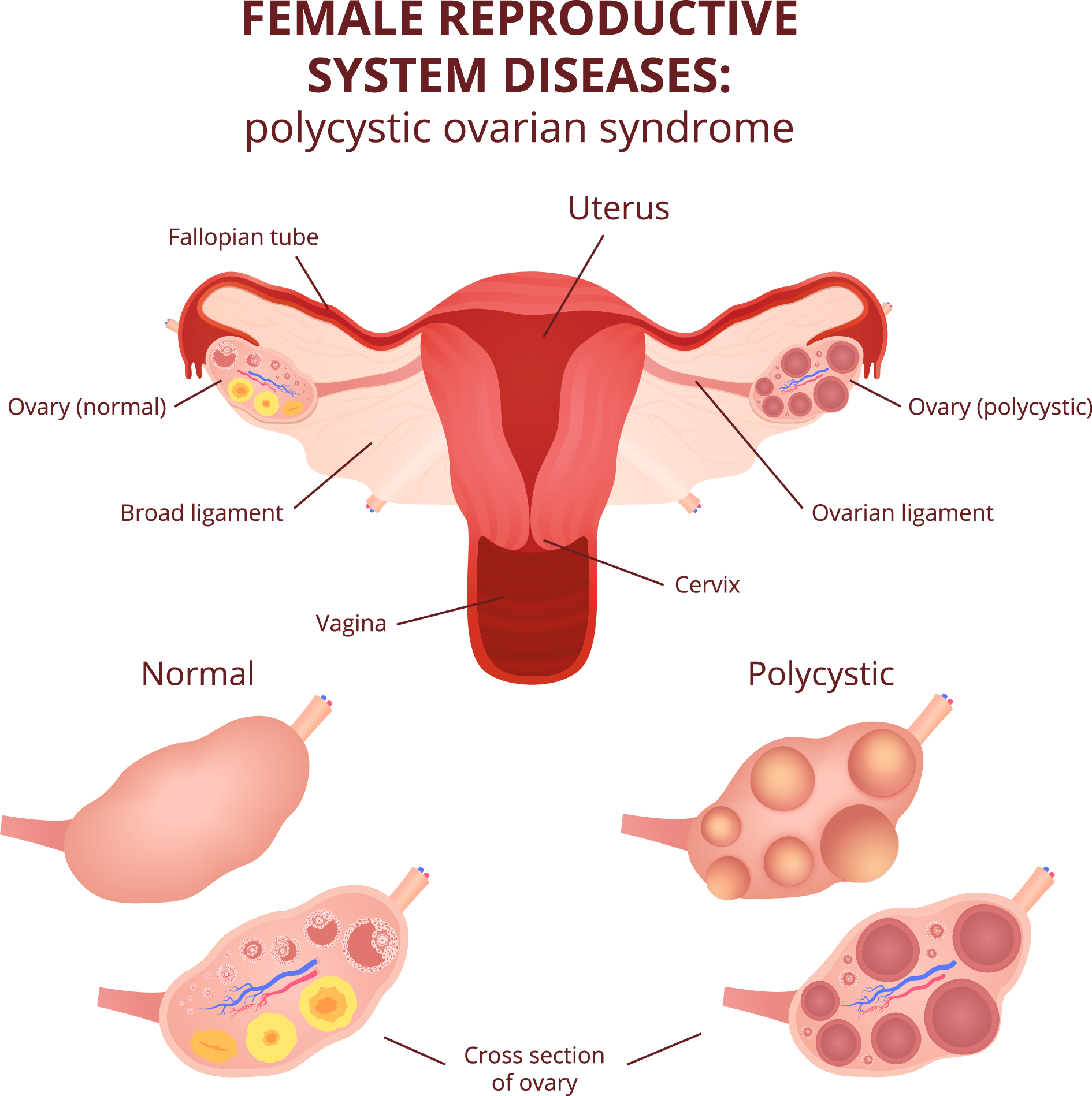 Polycystic Ovary Syndrome Polycystic Ovary Syndrome