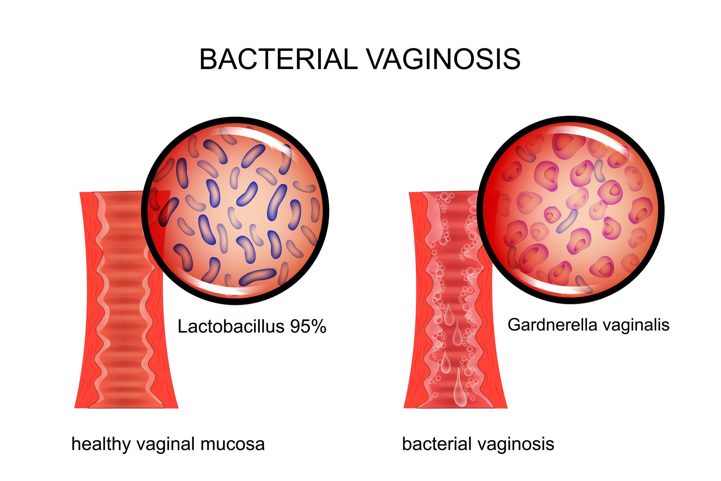 Vaginal Infections image 