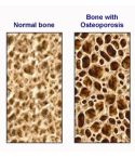 Osteoporosis Bone Turnover Test by Post