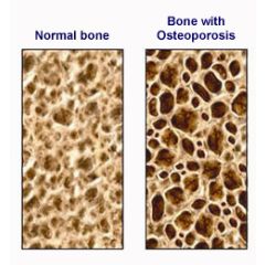 Osteoporosis Bone Turnover Test by Post